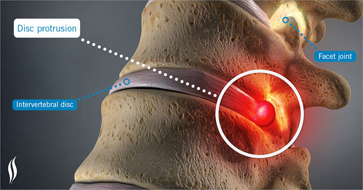 Foraminal Stenosis 